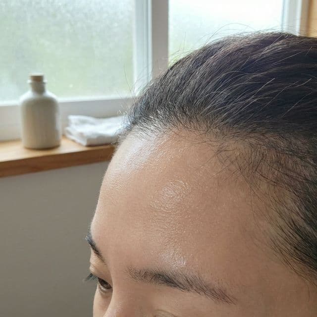 How to Get Rid of Forehead Acne: A Clear Skin Roadmap