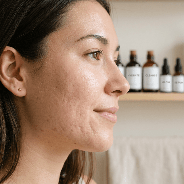 Will Acne Scars Vanish? Understanding and Treating Scarring