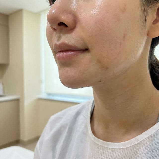 How to Get Rid of Cystic Acne: A Dermatologist's Guide to Clear Skin