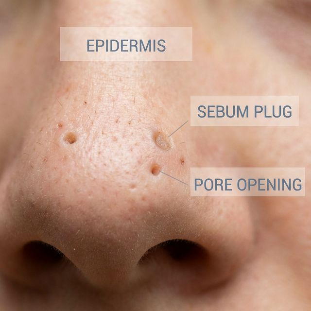 What Do Clogged Pores Look Like & How to Tackle Them